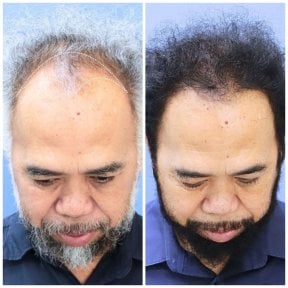 before-after photo hair-transplant