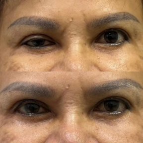 Resultados de blefaroplastia antes y después: corrección de párpados y mirada rejuvenecida