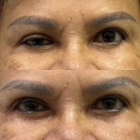 Resultados de blefaroplastia antes y después: corrección de párpados y mirada rejuvenecida
