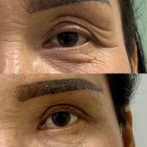 Resultados de blefaroplastia antes y después – menos arrugas y piel más lisa en párpados