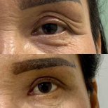 Resultados de blefaroplastia antes y después – menos arrugas y piel más lisa en párpados