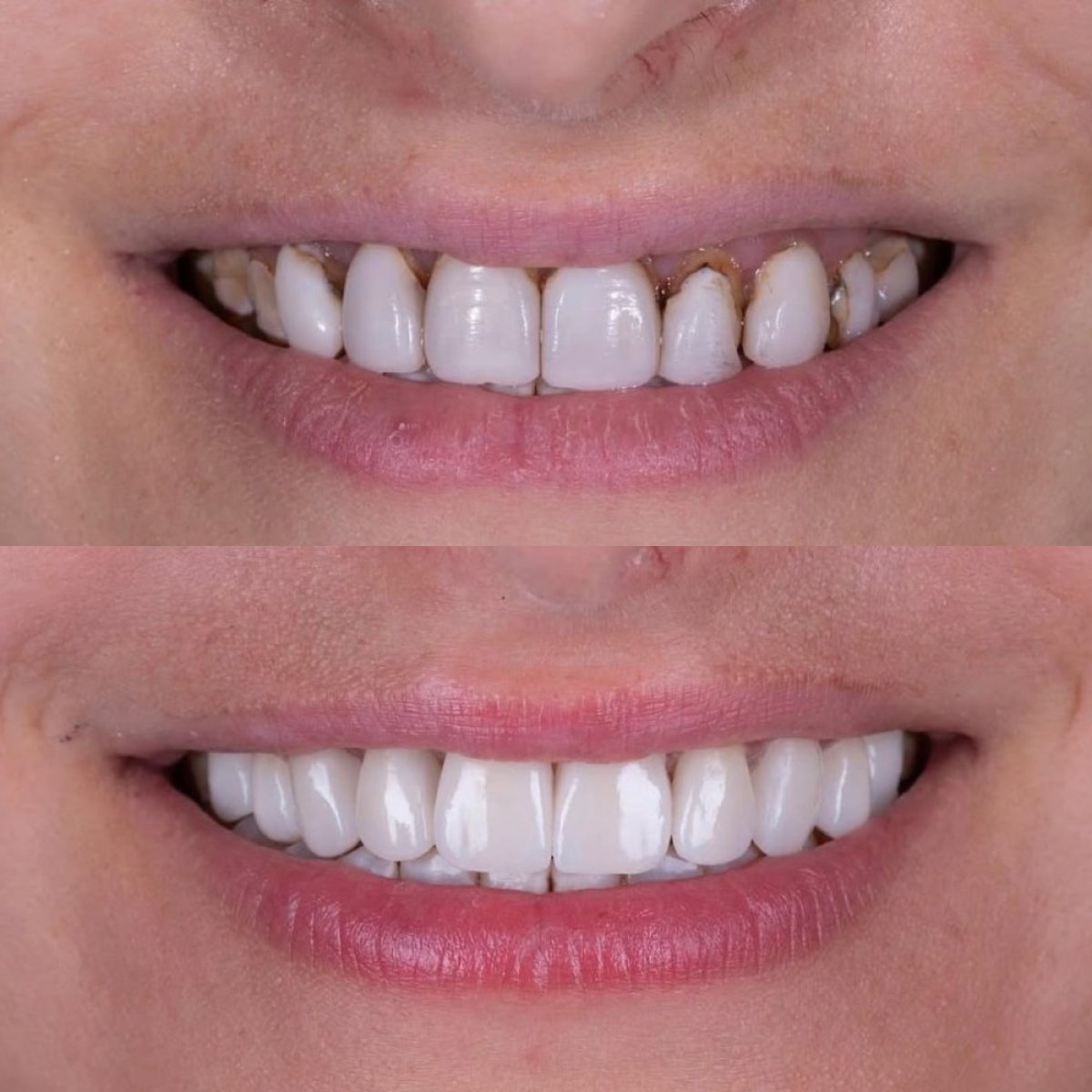 نتيجة قبل وبعد زراعة الأسنان All-on-6 في عيادة Shtern Dental، ابتسامة محسنة