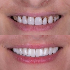 Before and after All-on-6 dental implants result at Shtern Dental Clinic, improved smile