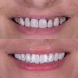 Before and after All-on-6 dental implants result at Shtern Dental Clinic, improved smile