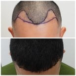 Resultados antes y después de trasplante capilar en Department of Skin & Surgery - NAVAMIN9 HOSPITAL