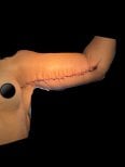 Résultat lifting des bras (brachioplastie) chez Lucio Santos Plastic Surgery, cicatrice visible