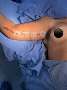 Résultat post-opératoire lifting des bras chez Lucio Santos Plastic Surgery, cicatrice visible