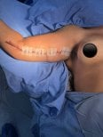 Résultat post-opératoire lifting des bras chez Lucio Santos Plastic Surgery, cicatrice visible