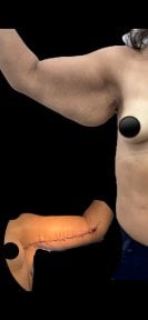 Résultats avant/après lifting des bras (brachioplastie) chez Lucio Santos Plastic Surgery