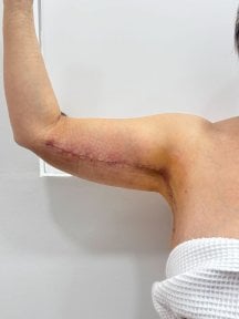 Résultat lifting des bras (brachioplastie) chez Lucio Santos Plastic Surgery, contour amélioré