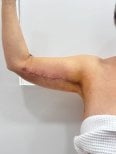 Résultat lifting des bras (brachioplastie) chez Lucio Santos Plastic Surgery, contour amélioré