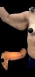 Vorher-nachher-Ergebnisse der Oberarmstraffung bei Lucio Santos Plastic Surgery, verbesserte Kontur