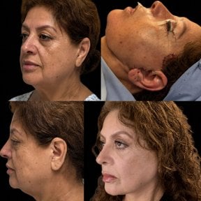Resultados antes y después de deep plane facelift en Lucio Santos Plastic Surgery, rejuvenecimiento facial