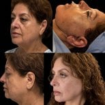 Resultados antes y después de deep plane facelift en Lucio Santos Plastic Surgery, rejuvenecimiento facial
