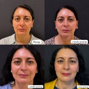 Resultados antes y después de deep plane facelift en Lucio Santos Plastic Surgery, rejuvenecimiento facial