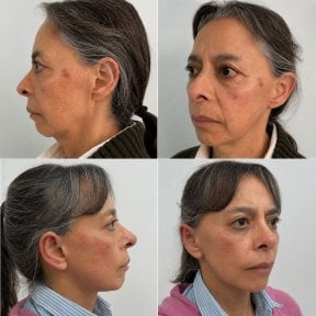 Resultados antes y después de deep plane facelift en Lucio Santos Plastic Surgery, rejuvenecimiento facial