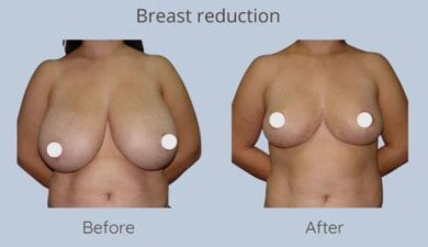 Результаты до и после уменьшения груди в ID Clinic Bangkok, видимое изменение формы