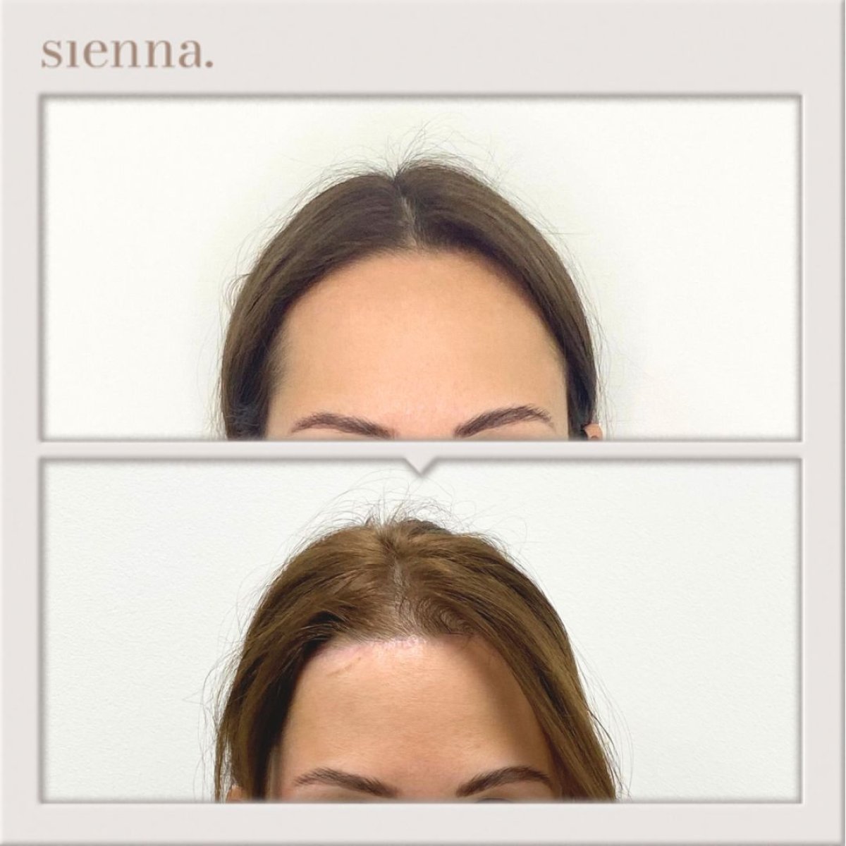 Resultados de lifting de frente antes y después en Sienna Clinic, frente más lisa visible