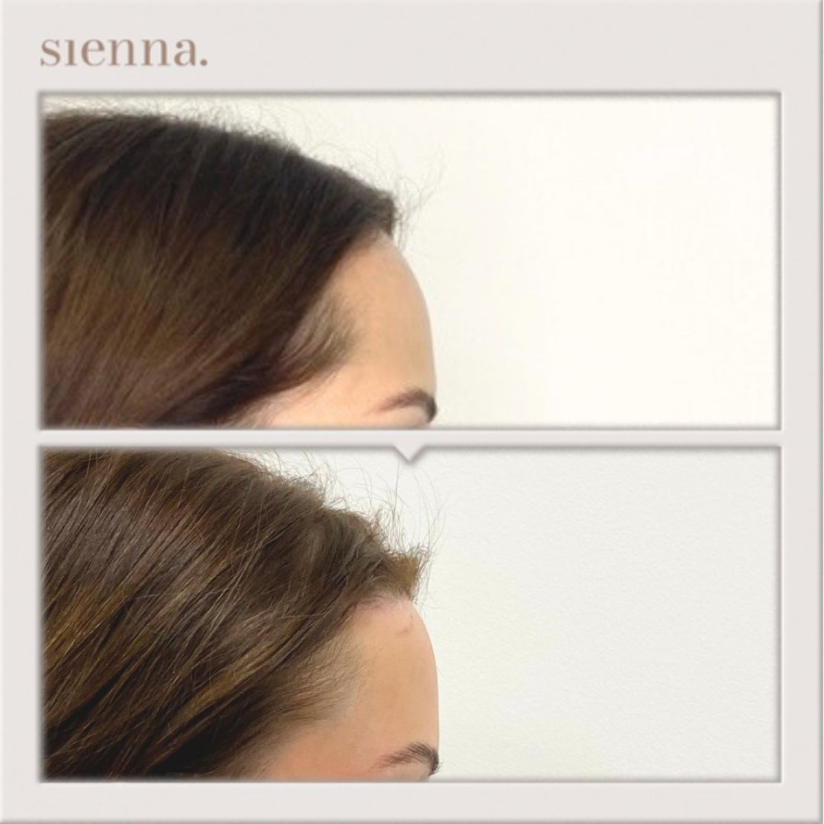 Resultados de lifting de frente antes y después en Sienna Clinic, contorno más suave