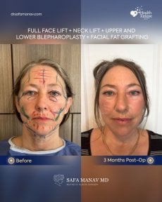 before-after photo facial-fat-transfer