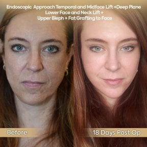 before-after photo facial-fat-transfer