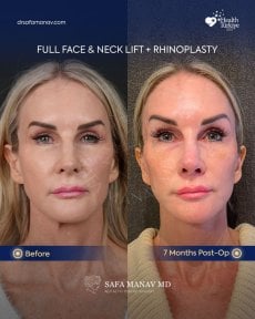 before-after photo facial-fat-transfer