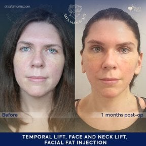 before-after photo facial-fat-transfer