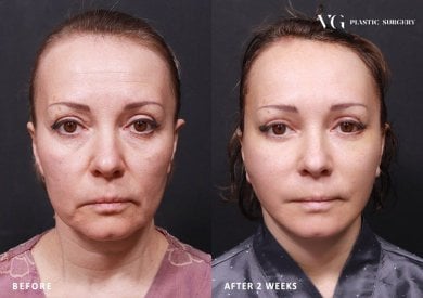 نتائج شد الجفن السفلي قبل وبعد في VG Plastic Surgery، تجديد شباب العينين