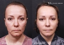 نتائج شد الجفن السفلي قبل وبعد في VG Plastic Surgery، تجديد شباب العينين
