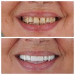 Результаты до и после Hollywood Smile в Nifa Dent International – обновление улыбки винирами
