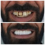 Результаты до и после Hollywood Smile в Nifa Dent International – преображение улыбки винирами