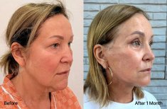 Resultados de blefaroplastia inferior antes y después en View Plastic Surgery Hospital, 1 mes