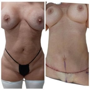Resultados de abdominoplastia antes y después en Hospital de la Familia, contorno mejorado