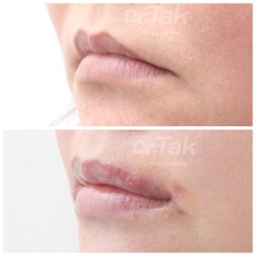 Resultados de antes y después de lip lift en Dr. Tak Plastic Surgery, contorno mejorado