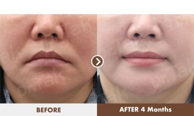 Resultados de lip lift antes y después en Dr. Tak Plastic Surgery, contorno mejorado tras 4 meses