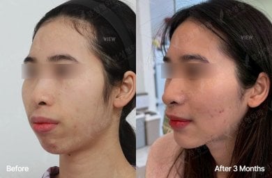 Результати ортогнатичної хірургії до і після у View Plastic Surgery Hospital, покращена лінія щелепи
