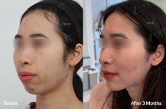 Результати ортогнатичної хірургії до і після у View Plastic Surgery Hospital, покращена лінія щелепи