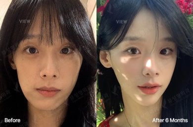 Результати до і після ортогнатичної операції у View Plastic Surgery Hospital, 6 місяців