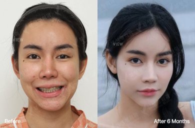 Before and after orthognathic surgery results at View Plastic Surgery Hospital, 6 months post-op