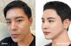 Результати ортогнатичної хірургії до і після у View Plastic Surgery Hospital, покращена лінія щелепи