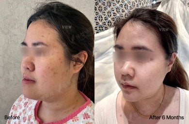 Результати ортогнатичної хірургії до і після у View Plastic Surgery Hospital, 6 місяців