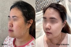 Результати ортогнатичної хірургії до і після у View Plastic Surgery Hospital, 6 місяців