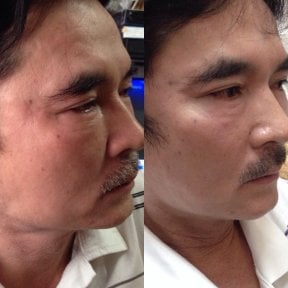 Avant/après lifting par fils à ASIA CLINIC, résultat de raffermissement et rajeunissement