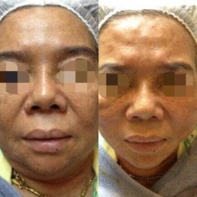 Avant et après lifting par fils à ASIA CLINIC, résultat de raffermissement du visage