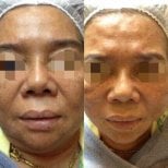 Avant et après lifting par fils à ASIA CLINIC, résultat de raffermissement du visage