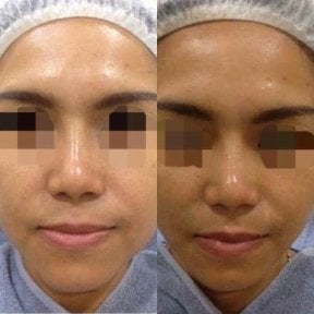 Résultat avant et après lifting par fils à ASIA CLINIC, raffermissement visible du visage