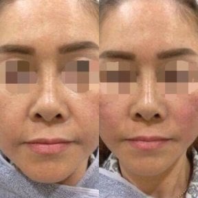Avant et après lifting par fils à ASIA CLINIC, résultat de raffermissement du visage