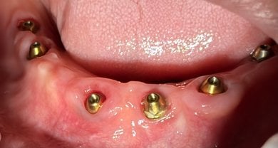 Dental implant placement result at Shanghai Y+bo Dental Clinic, visible abutments in lower jaw