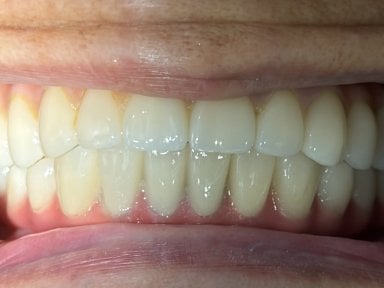 Dental implant result at Shanghai Y+bo Dental Clinic – restored natural-looking smile