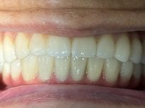 Dental implant result at Shanghai Y+bo Dental Clinic – restored natural-looking smile